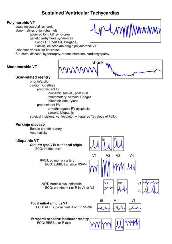 RVOT / LVOT tachycardia - EPpedia